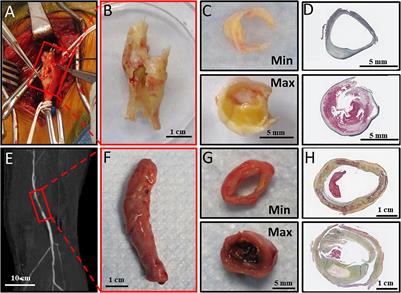 Altered Peroxisome Proliferator-Activated Receptor Alpha Signaling in Variably Diseased Peripheral Arterial Segments